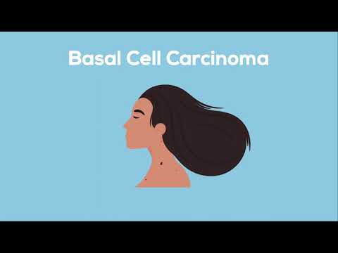 What is Advanced Basal Cell Carcinoma?