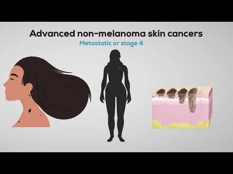 What is Non-Melanoma Skin Cancer?