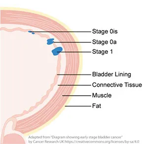 non-muscle_invasive_bladder_cancer_its_treatment.web_.jpg