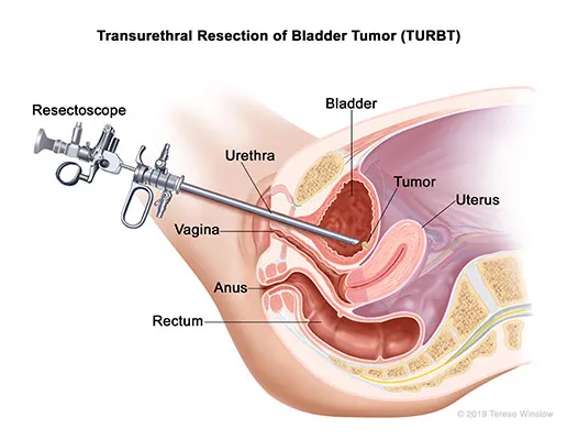 turbtfemale.jpg