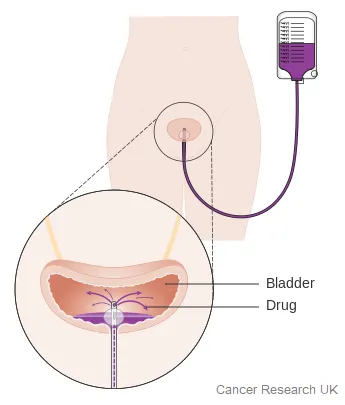 Bladder Graphic 1.4