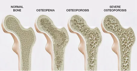 bone health infographic