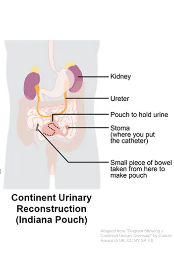 continent urinary reconstruction