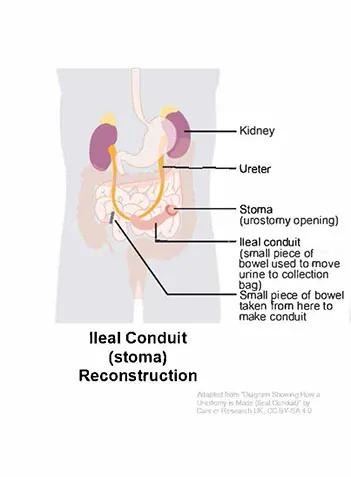 ileal conduit reconstruction chart