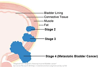 Treatment for Muscle-Invasive Bladder Cancer | Cancer Support Community