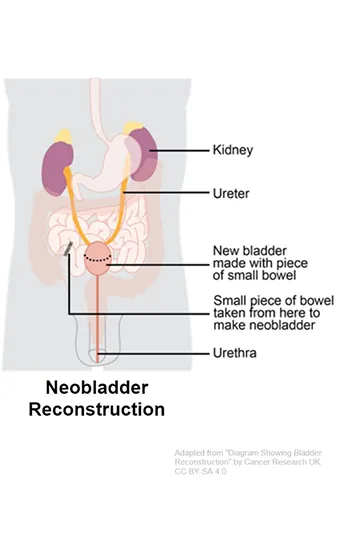 neobladder reconstruction