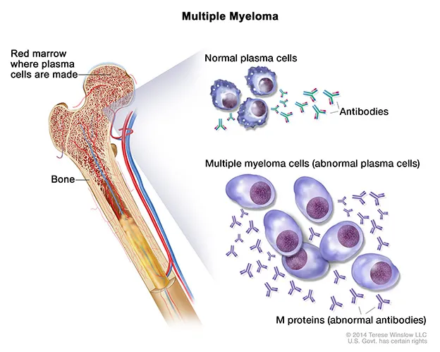 Survey on patient preferences for myeloma treatment - Myeloma