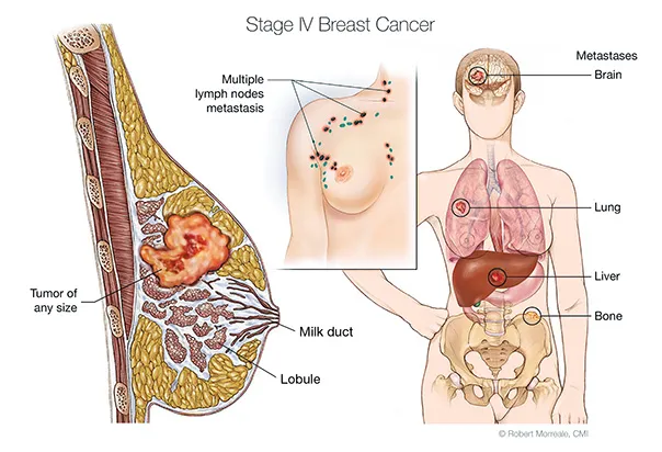 stage IV breast cancer