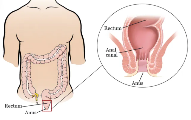 Anal Cancer diagram graphic