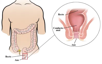 Anal Cancer Graphic ES 