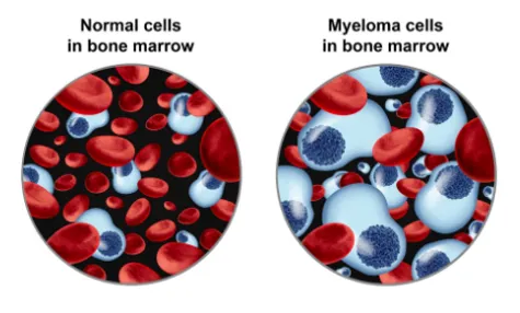 Myeloma vs Normal cells